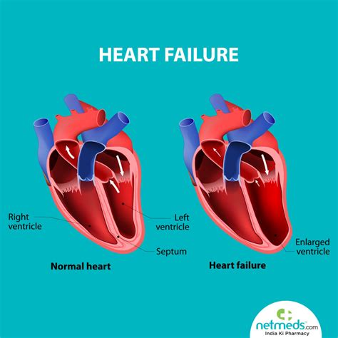 causes of left ventricular dysfunction.